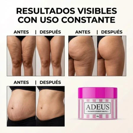 ADEUS | Tratamiento Intensivo Contra Celulitis, Estrías y Flacidez