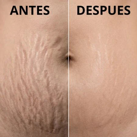 ADEUS | Tratamiento Intensivo Contra Celulitis, Estrías y Flacidez