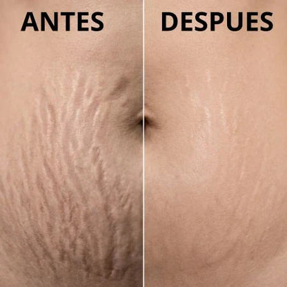 ADEUS | Tratamiento Intensivo Contra Celulitis, Estrías y Flacidez